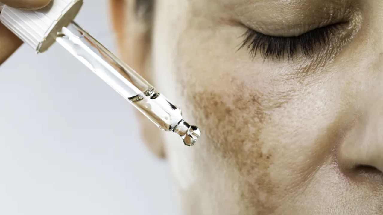 Controle do Melasma