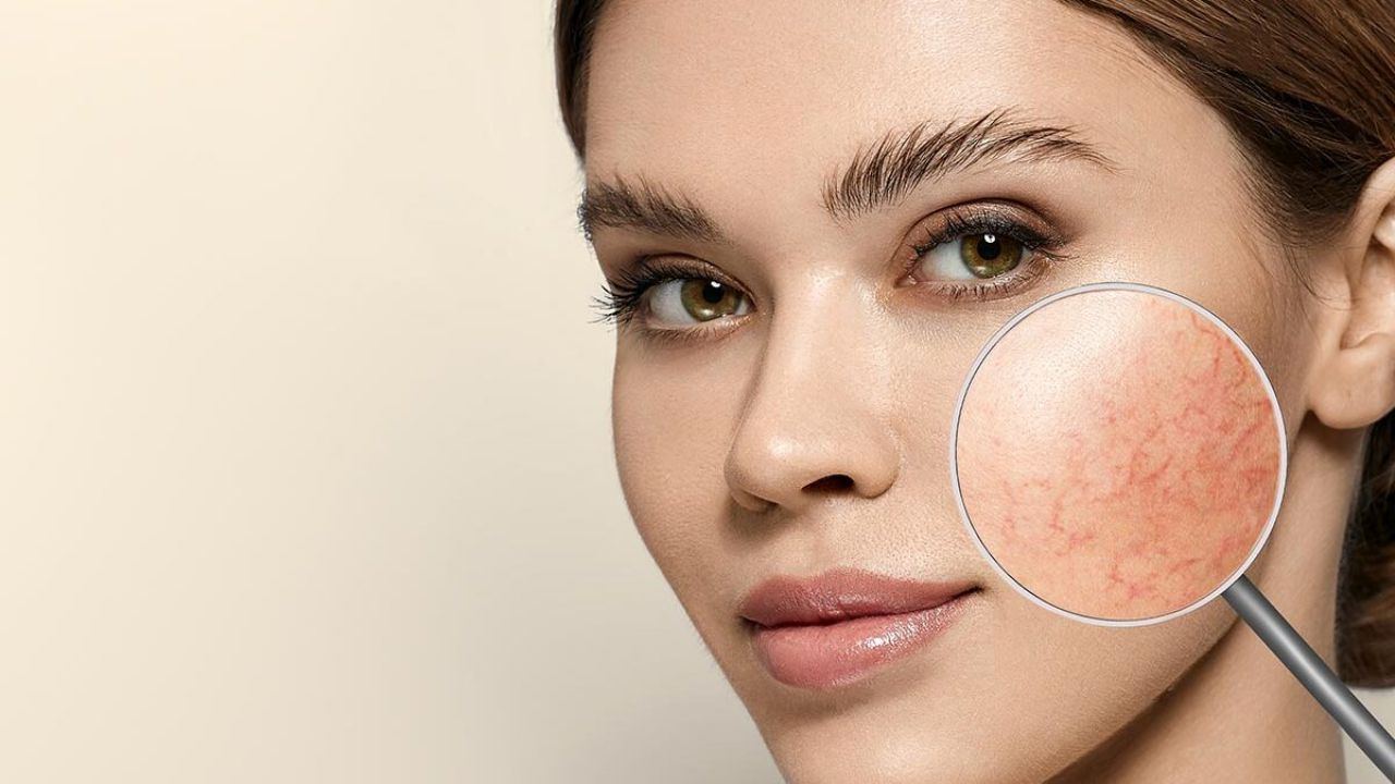 Rosácea: Compreensão e Cuidados para a Pele Sensível e Reativa