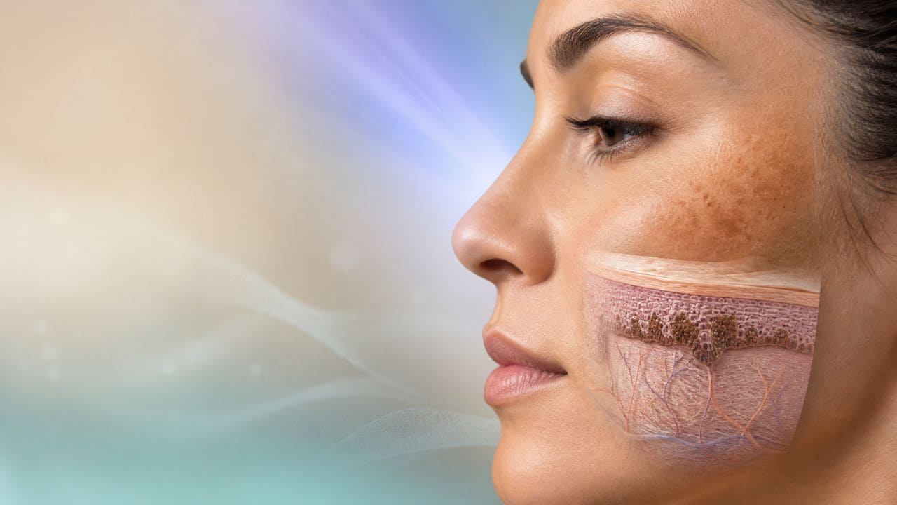 Controle do Melasma e Manchas Faciais